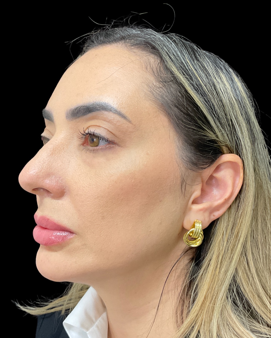 After - 36-Year-Old Female — Midface & Jawline Fat Restoration