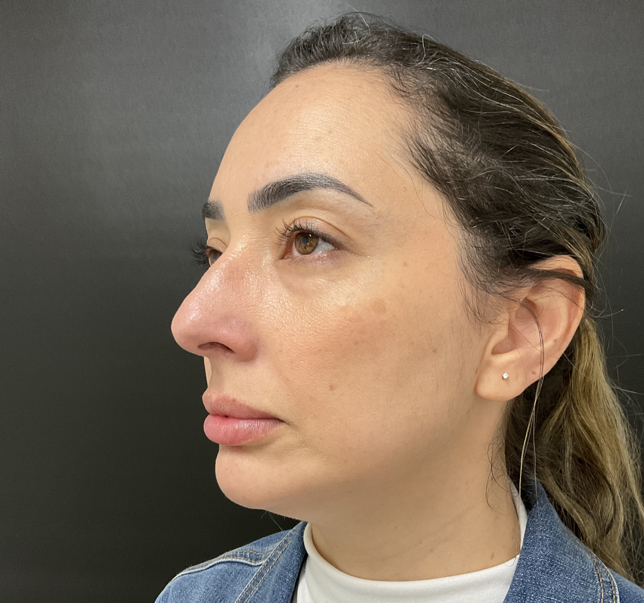 Before - 36-Year-Old Female — Midface & Jawline Fat Restoration